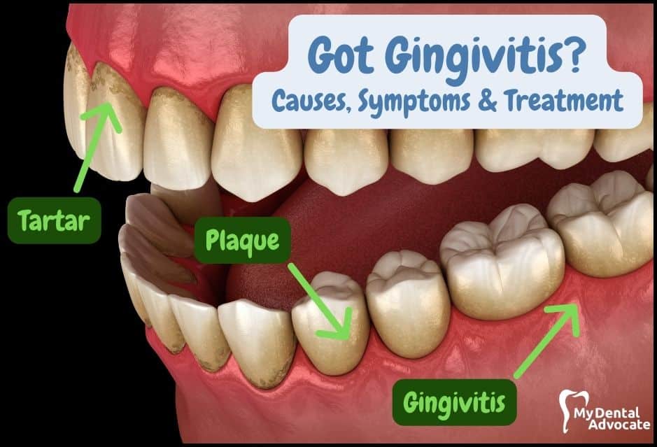 how to know if you have gingivitis Gingivitis disease periodontal dental problems