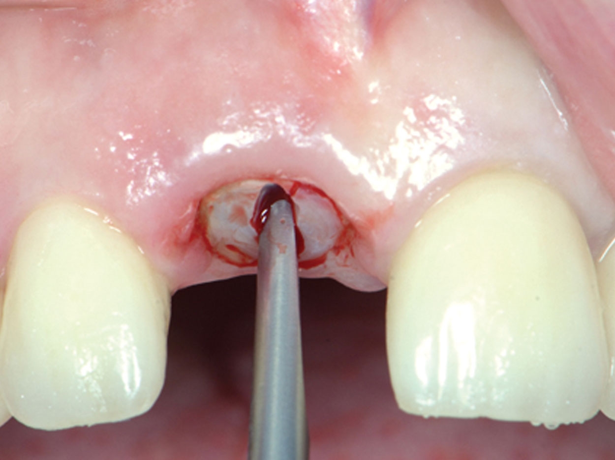 How to Extract Teeth as Atraumatically as Possible: Root Sectioning