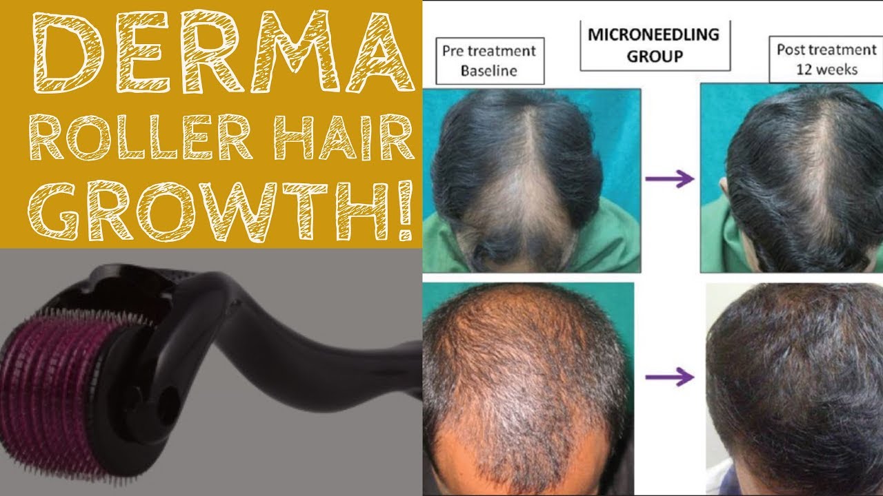 how often to use derma roller for hair growth 540 titanium microneedle roller for face facial wrinkles hair loss