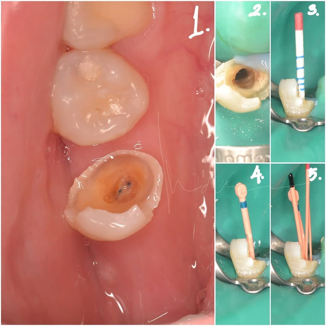 how long does a root canal take to heal How long does root canal take?