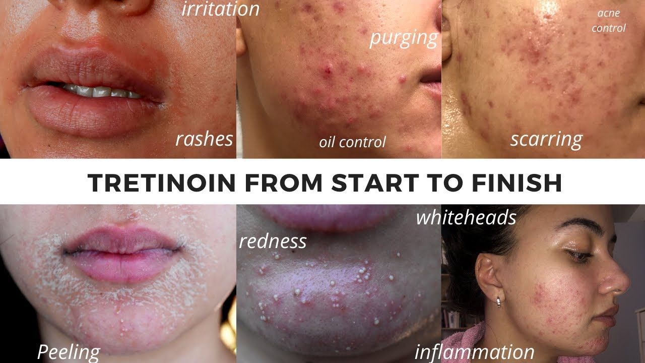 how long for tretinoin to work Tretinoin before and after for 5 skin problems- best for acne? find out