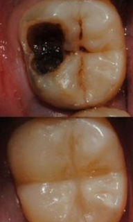 how much does it cost to get a cavity filled Dentist filling a cavity between teeth