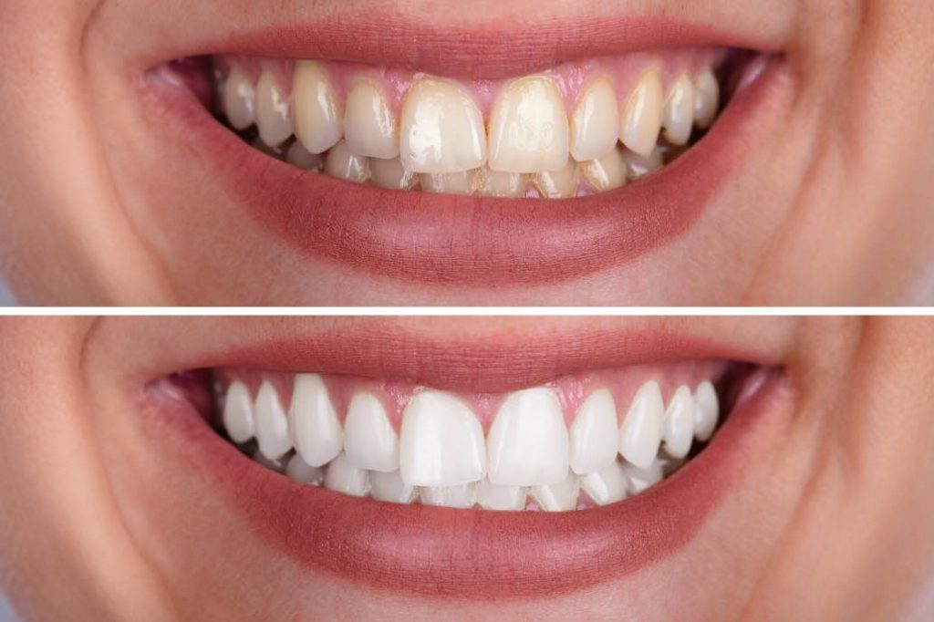 how long does it take to whiten teeth Whitening whiten braces dentistry barton orthodontics hinsdale