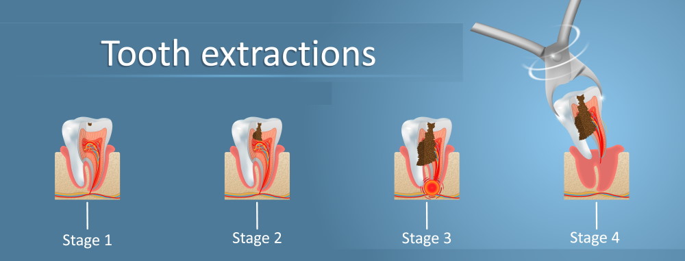 Tooth Extraction | Huntington Beach, CA | Pain relief with Oral surgery