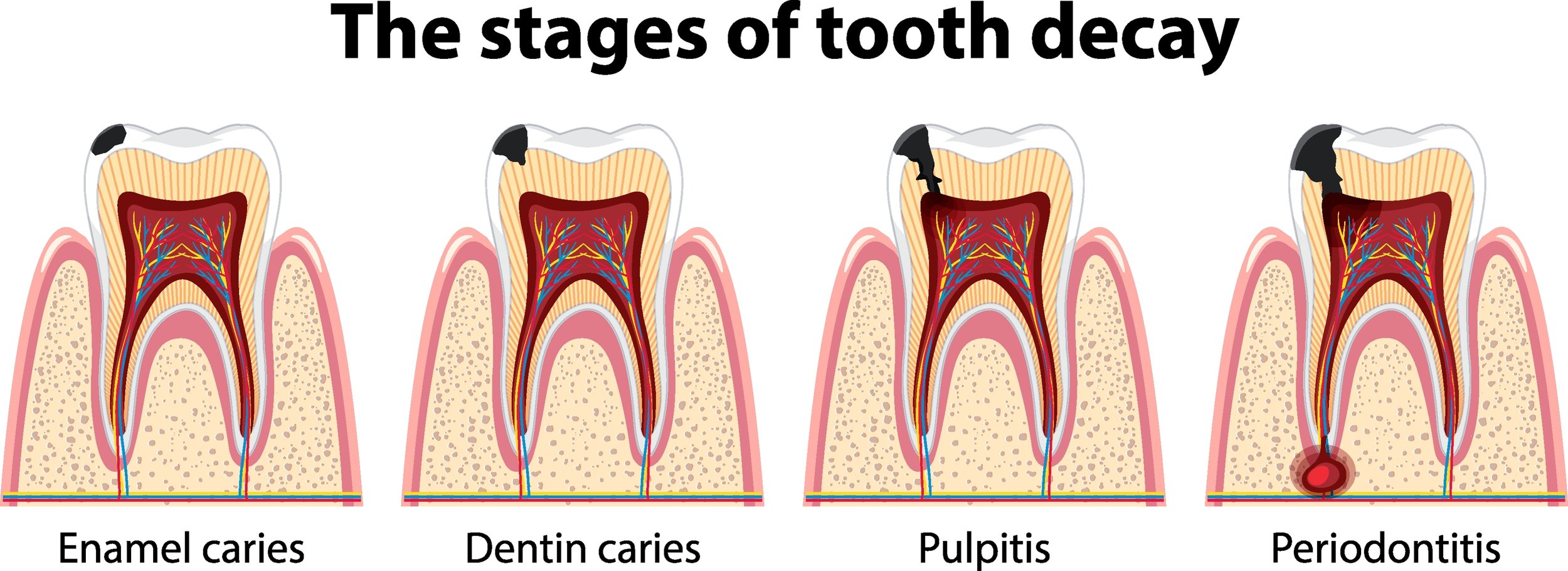 how long does it take to get a cavity filled Cavity tooth starts cavities decay caries stagnation dentist areas substance bacteria bacterial