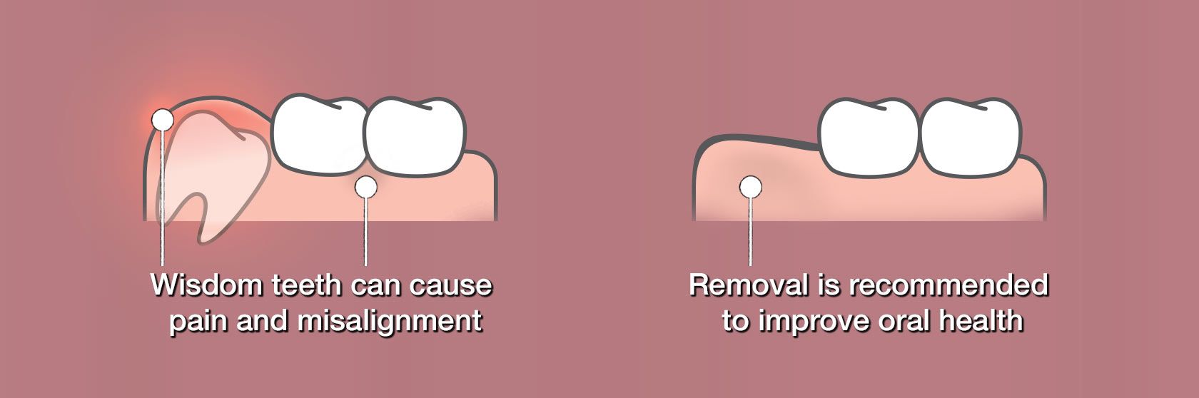 how to brush teeth after wisdom teeth removal How to brush your teeth after wisdom teeth removal