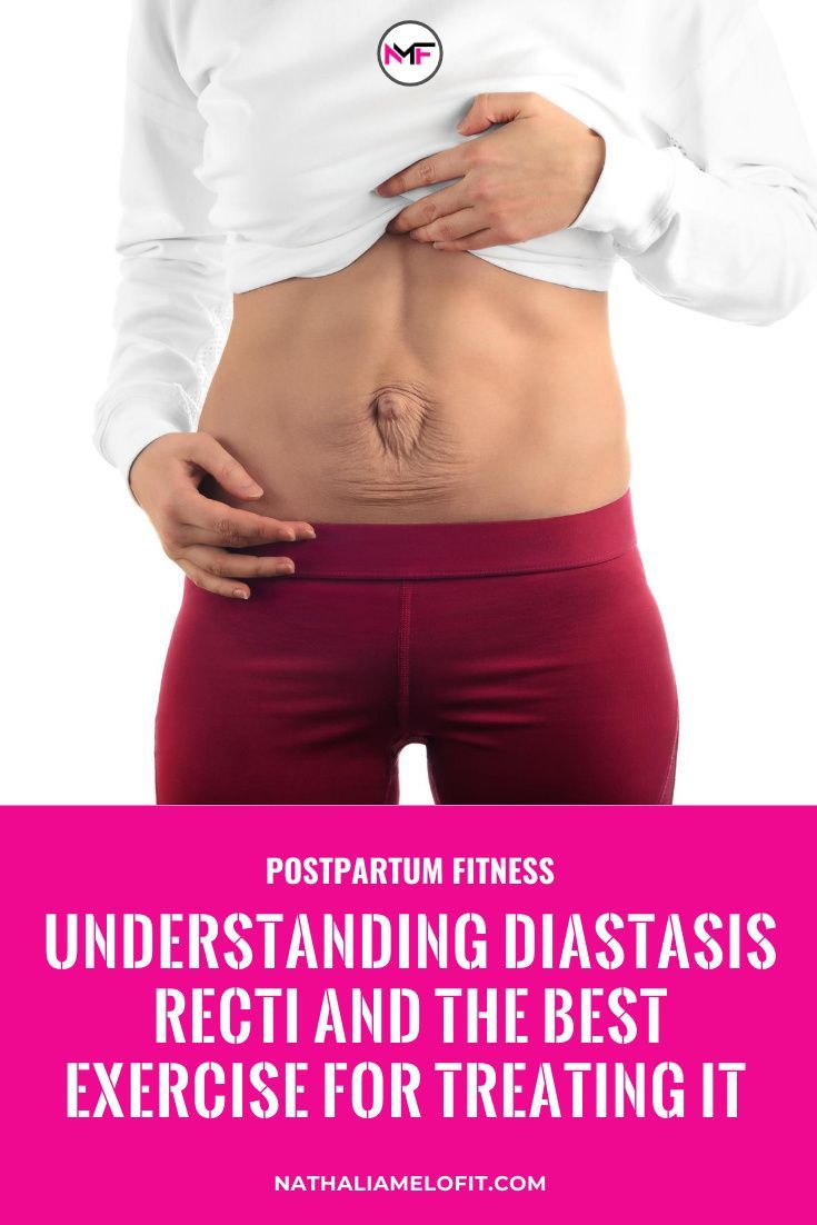 how to know if you have diastasis recti Diastasis recti exercises