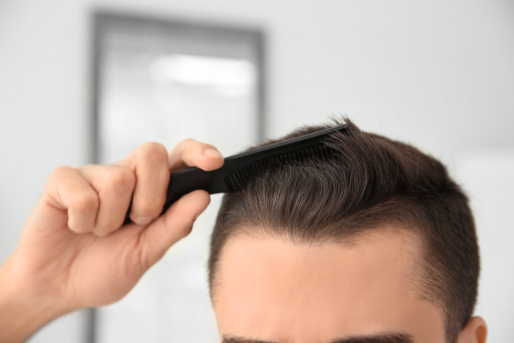 how to tell if your hairline is receding Receding hairline: treatment, stages, and causes