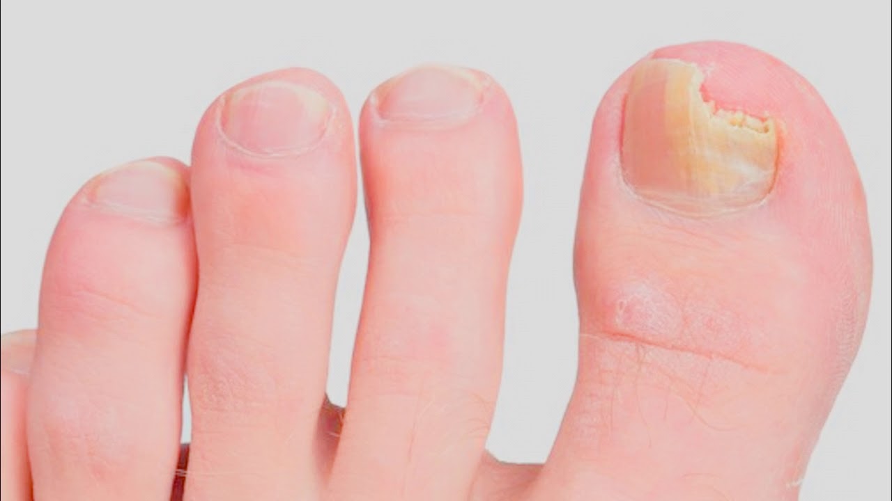 how long does it take bleach to kill toenail fungus How to get rid of toenail fungus with bleach