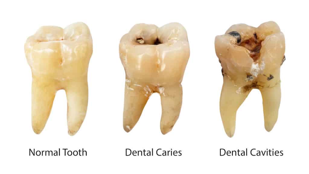 What Does a Cavity Look Like? (Complete Photo Guide)