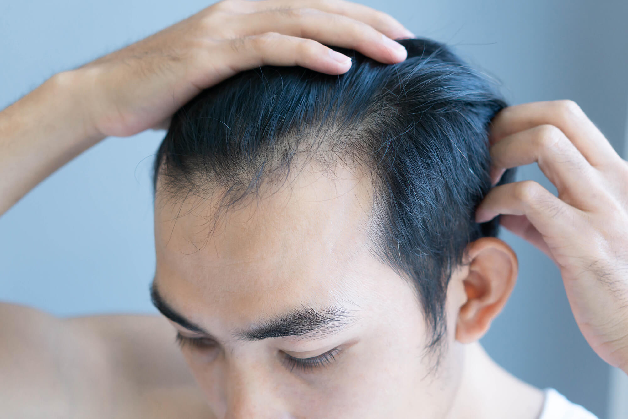 Should I be worried about my receding hairline? - myhair