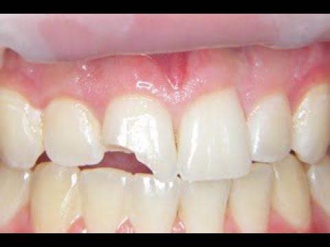 Temporary Chipped Tooth Repair At Home | Taraba Home Review