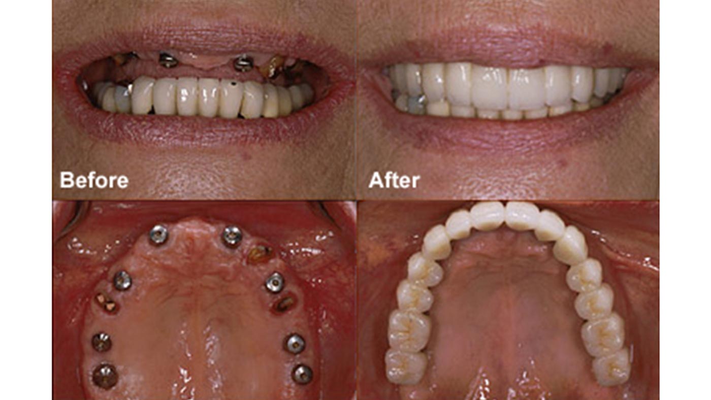 how much to implant one tooth Cost of dental implants – best implant & dentures dentist in the