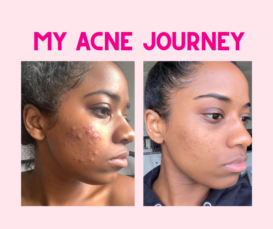 My Adult Acne Journey: How Tretinoin Helped Clear my Skin — Mixed Makeup