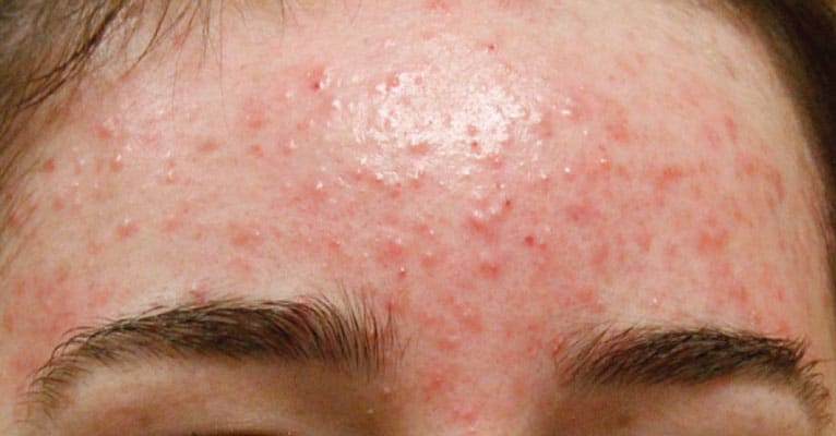 how to get rid of acne on forehead 4 ways to get rid of forehead acne