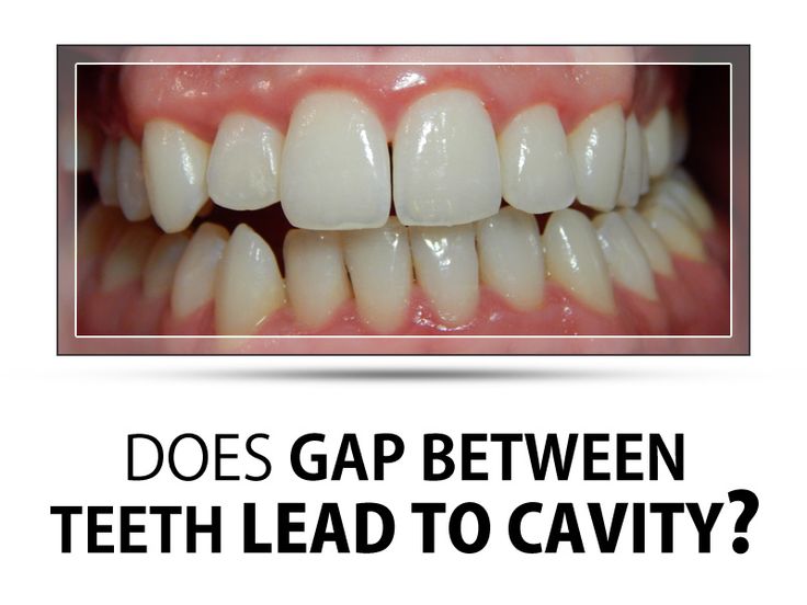 how to reduce gap between teeth naturally at home Diastema gaps