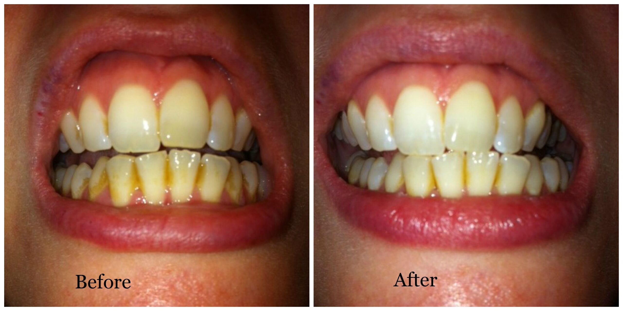 how to remove teeth stains Removal of superficial tooth stains gallery – dr. jack m. hosner, d.d.s.